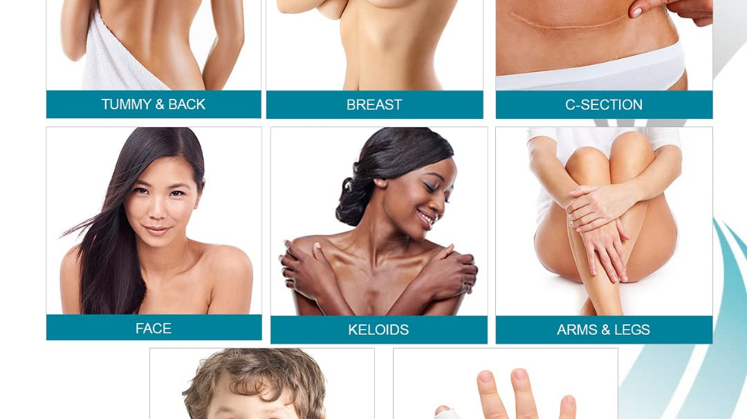 Newgel+ silicon gel & sheat scars treatment | health boutique