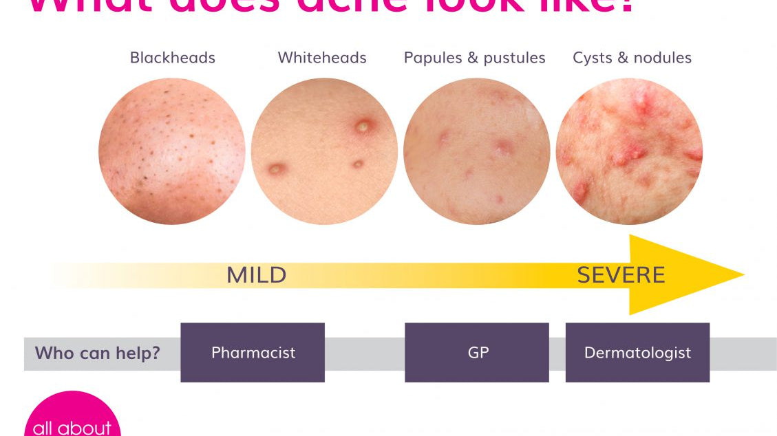 PanOxyl Face Wash: The Best Acne Treatment in Jordan