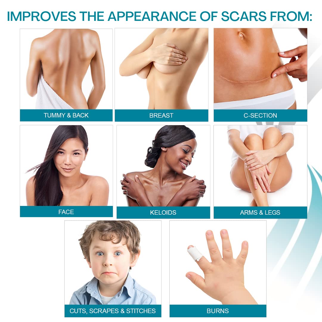 Newgel+ silicon gel & sheat scars treatment | health boutique 
