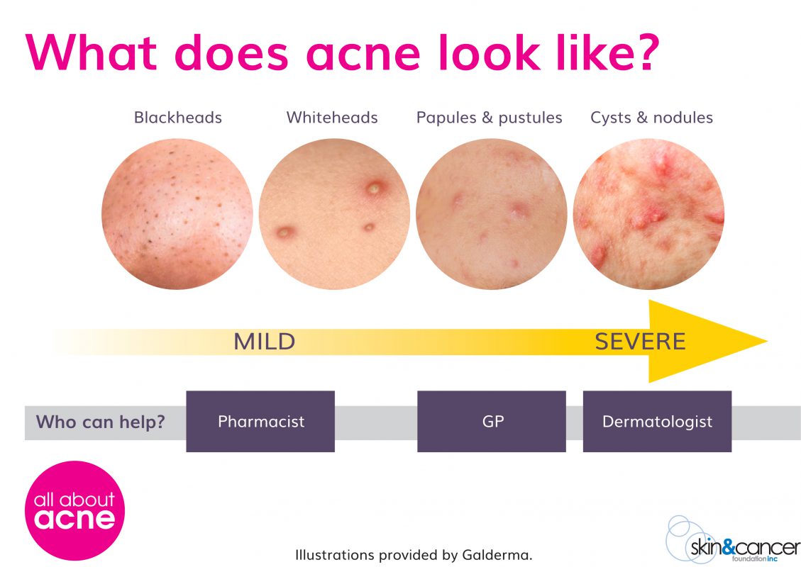 PanOxyl Face Wash: The Best Acne Treatment in Jordan