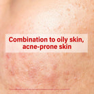 ACM Sebionex Salicylic Acid AHA Niacinamide Anti Acne Soothing Cream 40ml Health Boutique