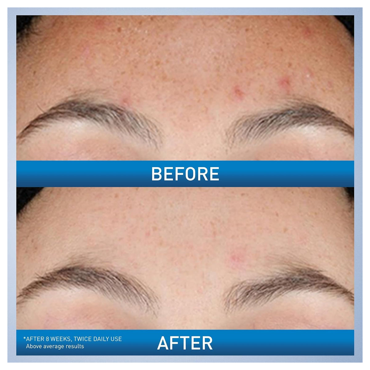 CeraVe retinol niacinamide ceramide resurfacing serum 30ml acne marks pores skin texture Health Boutique